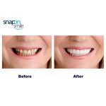 Pack Of 2 Pairs Snap-On Smile Custom Fit Perfect Smile Veneers In 3 Easy Steps - Image 7