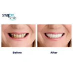 Pack Of 2 Pairs Snap-On Smile Custom Fit Perfect Smile Veneers In 3 Easy Steps - Image 2