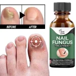 Fast Nail Fungal Treatments Oil Nail Repair Essences Serum Care Treatments Foot Nail Fungus Removal Gel Paronychia Onychomycosis - Image 2