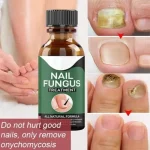 Fast Nail Fungal Treatments Oil Nail Repair Essences Serum Care Treatments Foot Nail Fungus Removal Gel Paronychia Onychomycosis - Image 3