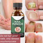Fast Nail Fungal Treatments Oil Nail Repair Essences Serum Care Treatments Foot Nail Fungus Removal Gel Paronychia Onychomycosis