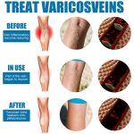 South Moon Varicose Veins Treatment Spray | Advanced Solution for Spider Veins, Leg Pain & Swelling Relief - Image 5